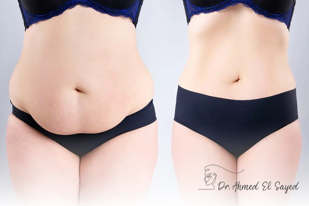 tummy-tuck-عملية tummy-tuck-عملية
